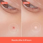 Pimple Patches for Face (1 Sheet Set) - Image 5