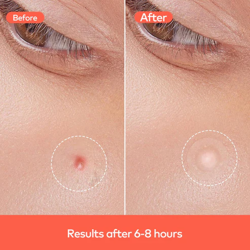 Pimple Patches for Face (1 Sheet Set) - Image 5